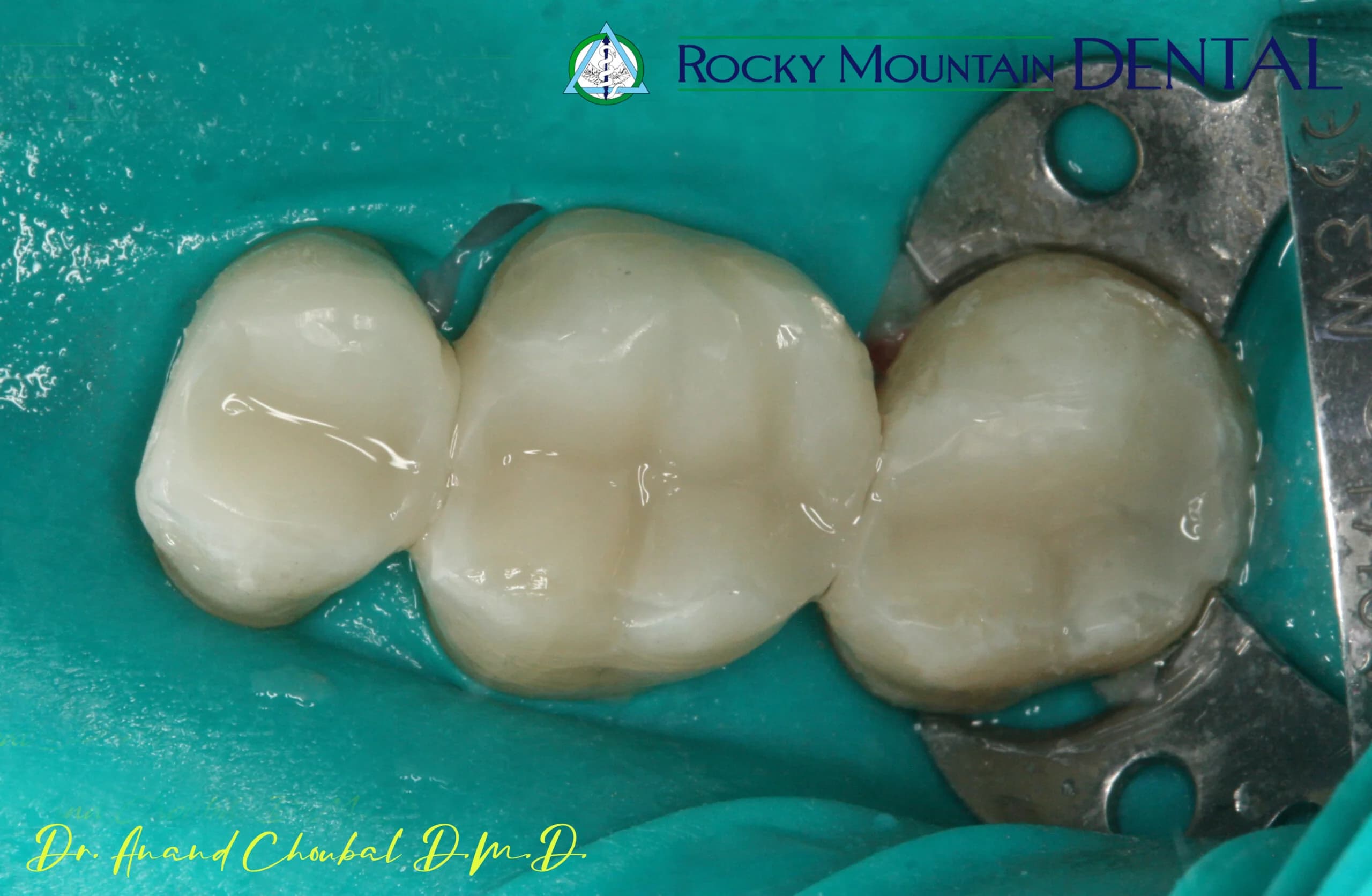 Close up of a titanium dental implant post
