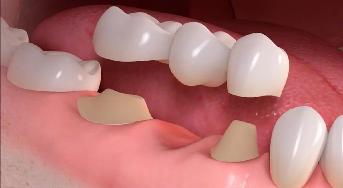Dental crown being fitted in Banff